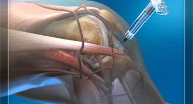 आर्थोपेडिक उत्पाद इंजेक्शन और पंचर उपकरण Hyaluronic एसिड घुटने इंजेक्शन